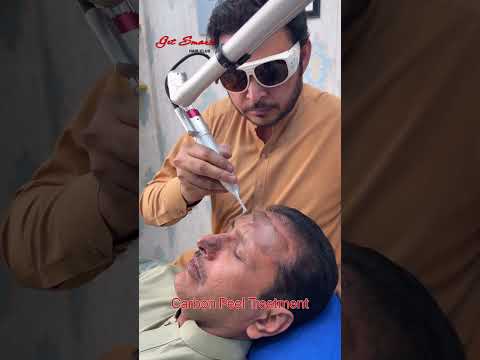 Carbon Peel Laser #getsmarthairclub #skincare #viralvideo #beauty