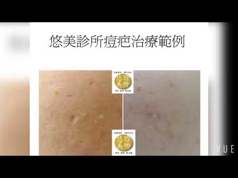 痘疤治療結果 低調做好自己的事 acne scar treatment