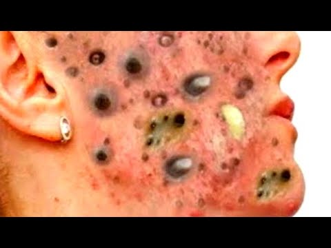 blackheads new this week