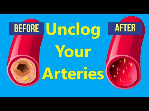 How to Unclog Your Arteries!!