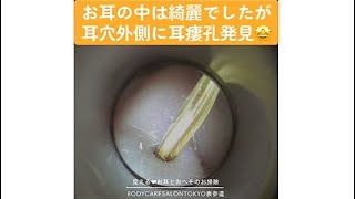 142 ＃耳掃除#耳かき#earwax【#耳瘻孔 発見！すぽっとポイント、何回かあります】