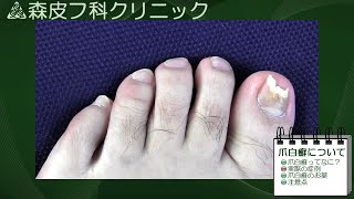 動画による皮膚病の解説　第５回　【爪白癬】