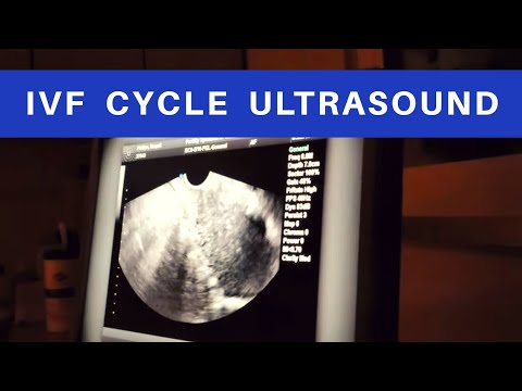 IVF FET Monitoring Appointment | IVF Cycle Ultrasound Appointment