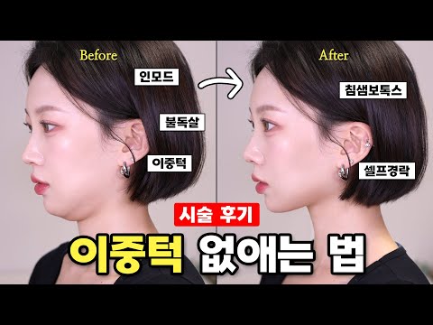 Treatment to get rid of chin fat ❓ Self-marrow massage that makes the face smaller🔥