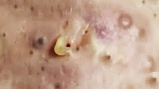 Big Open & Closed Blackheads Removal - The best Pimple Popping Videos