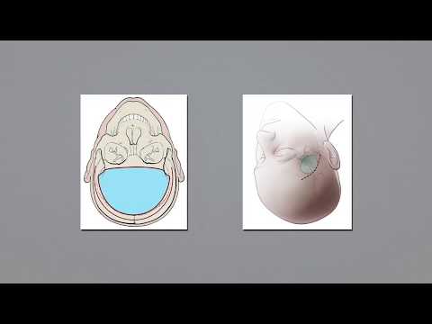 Mini-pterional approach for clip ligation of ethmoidal dural arteriovenous fistula