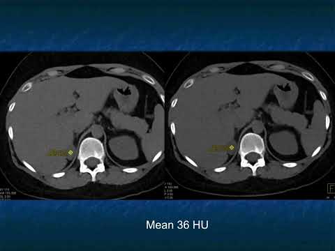 CT of the Large Adrenal Mass: Follow, Biopsy, Resect - Part 1