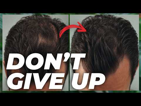 5 Finasteride Alternatives - Watch This if You CANT Use Finasteride