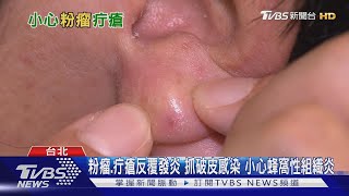 【十點不一樣】這個"病症"又癢.抓破皮..細菌感染.."蜂窩性組織炎"找上門