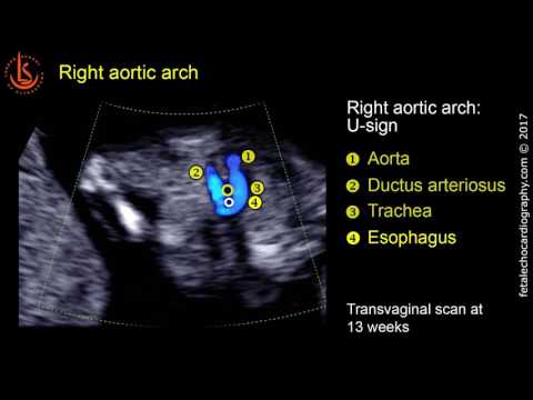 Fetal echocardiography at 11-13 weeks: Right Aortic Arch (RAA)