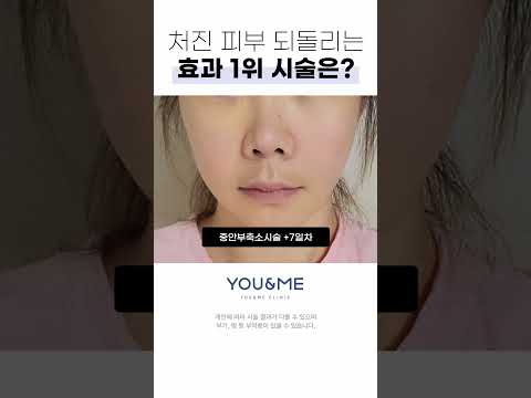 시간을 초월하는 강력한 시술을 소개합니다. #리프팅시술 #시술추천