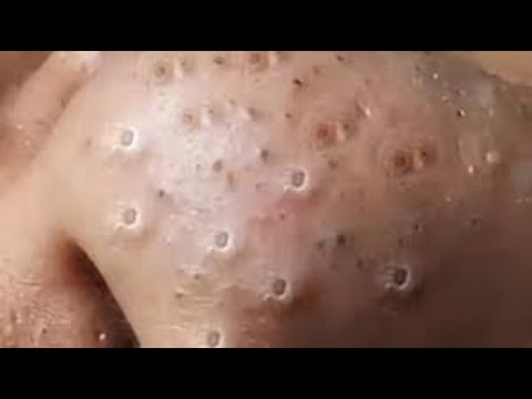 blackheads new this week