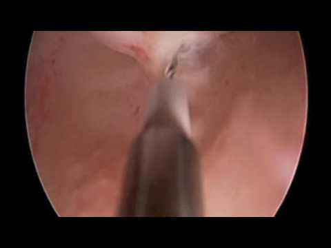 Polypectomy Hysteroscopic  with Versapoint & removal by forceps