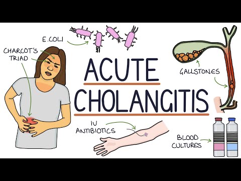 Understanding Acute Cholangitis (Ascending Cholangitis)