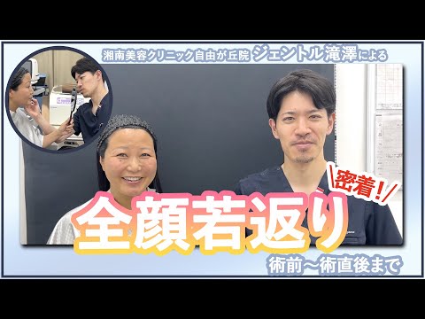 大人気！ジェントル式全顔若返り企画☆長野県からご来院の55歳女性☆part.①