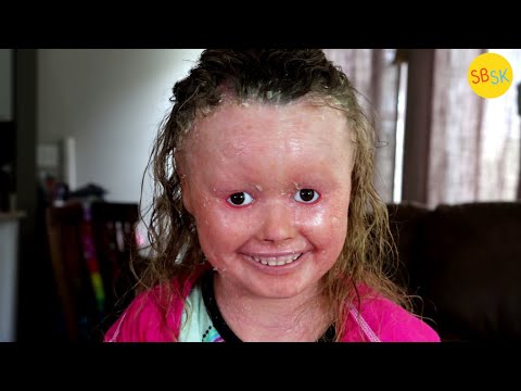 Living with Harlequin Ichthyosis (Skin that Grows 10x Too Fast)