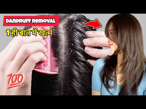 Hair Dandruff Problem Sulution 😱 | 💯 Dandruff kaise khatam kare | Dandruff Ke Liye Gharelu upaye