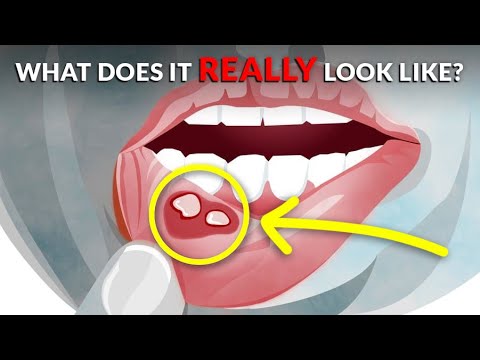 What Does A Canker Sore Look Like?