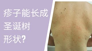 北美儿科/pityriasis rosea/玫瑰糠疹