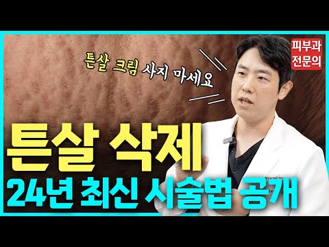 튼살 치료 이전에는 힘들었죠. 새로운 방법으로 지워드립니다! 튼살 레이저? 튼살 크림?