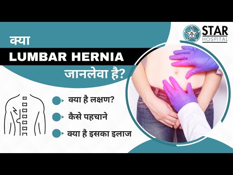 Lumbar Hernia in Hindi - Causes, Symptoms, Tests, Exercises & Treatment | Laparoscopic Management