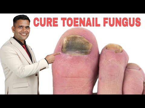 Best Toenail fungus Treatment Naturally | Cure Toe Nail Fungus at Home