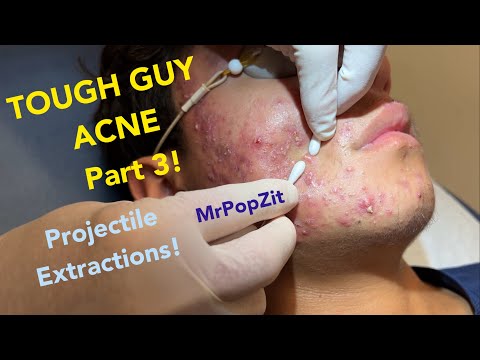 Tough Guy Acne part 3! Projectile extractions, very poppy. Follow his progress,links in description