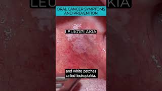 Recognizing early signs and preventing oral cancer 🎗️🚭