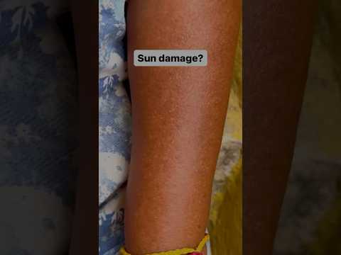 Sun damage? Try this! #shorts #deadskin #youtube #beautyhacks