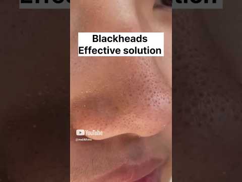 Blackheads & Whiteheads Remedy #skincare #beauty #beautytips