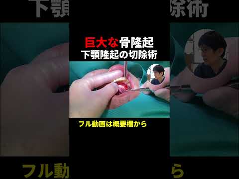 【巨大な骨隆起】下顎隆起の切除術/50代男性【15分ノーカット倍速解説】（歯科医ステップアップ）#口腔外科専門医 #安原歯科医院