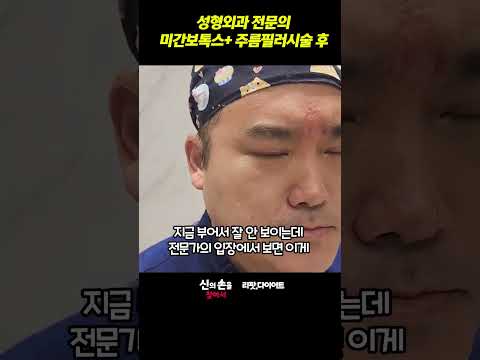 친오빠 성형외과 전문의 미간보톡스+주름필러시술후!!   #미간주름없애기 #미간주름보톡스 #미간주름필러 @drwellness5977