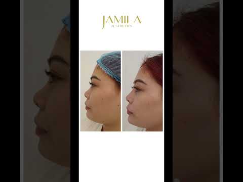 Non-surgical rhinoplasty at Jamila Aesthetics #jamilaaesthetics #nosefiller #iamjamila #beauty