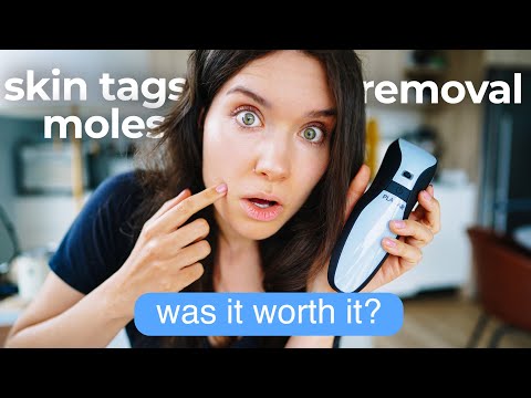 6 MONTH UPDATE: How to Get Rid of Skin Tags Moles Warts | PLASMA PEN MOLE SKIN TAG REMOVAL PEN