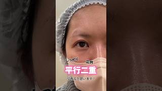 【ナチュラル！二重】全切開法でパッチリで自然な二重に✨#美容 #美容整形 #二重整形 #切開法 #整形 #shorts