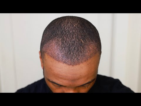 Hair Transplant Week 32