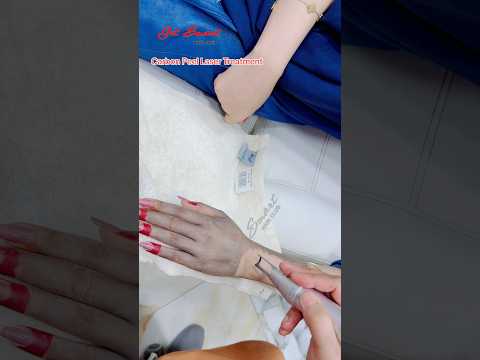 Carbon Peel Laser Treatment #getsmarthairclub #beauty #viralvideo