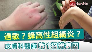 癢癢片》手腫得像哆啦Ａ夢？醫師：一招辨別是不是蜂窩性組織炎