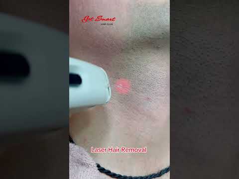 Laser Hair Removal #getsmarthairclub #skincare #viralvideo