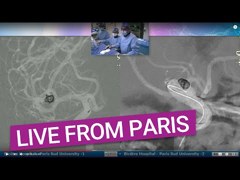 Treating bifurcation aneurysms with a stent diverter and coils