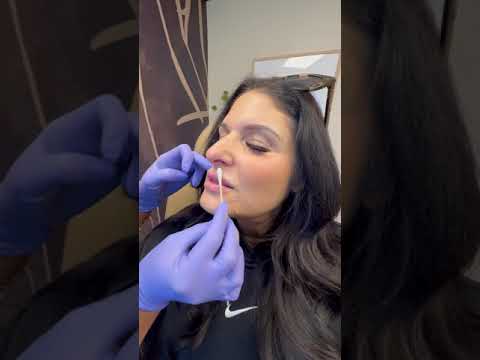 🌟COME WITH ME TO GET MY LIP FILLER DISSOLVED 🌟 #vlog #lipfiller #dayinthelife #atx