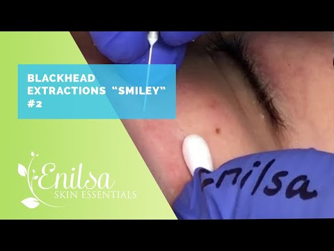 Extractions on "Smiley" treating Maturation Arrest Acne