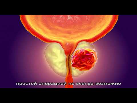 Новые методы лечения аденомы простаты