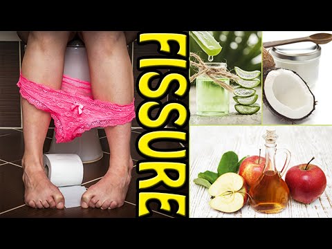 How to Cure Fissure Permanently at Home | 5 Best Treatment Options for Anal Fissures.