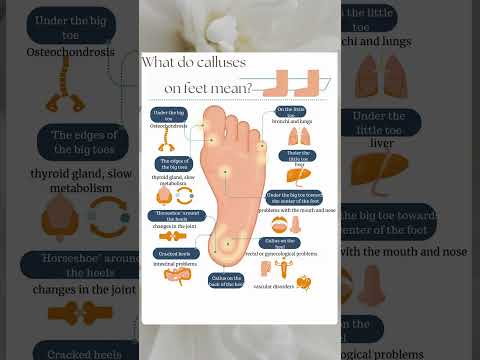 What do calluses on the feet mean? Diagnosis of body health