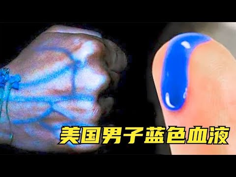 5件你从未见过的趣事，美国男子血液发蓝，难道是蓝精灵的原型？