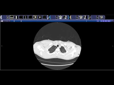 How to read a PE Chest CT