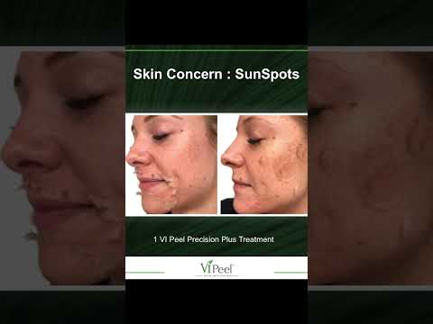 VI Peel Sun Spots Removal: Before & After photos at Plantation Med Spa, Florida #shorts