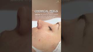 Which is better for Melasma: Lasers vs Peels | Ensoul Medical Clinic