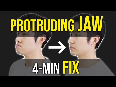 Protruding Jaw / Underbite Fix ｜Facial Asymmetry Correction｜Corrective Exercises